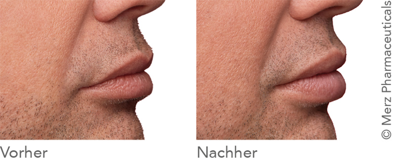 Belotero Lips Kampagne: Vorher - Nachher (Merz Pharmaceuticals)