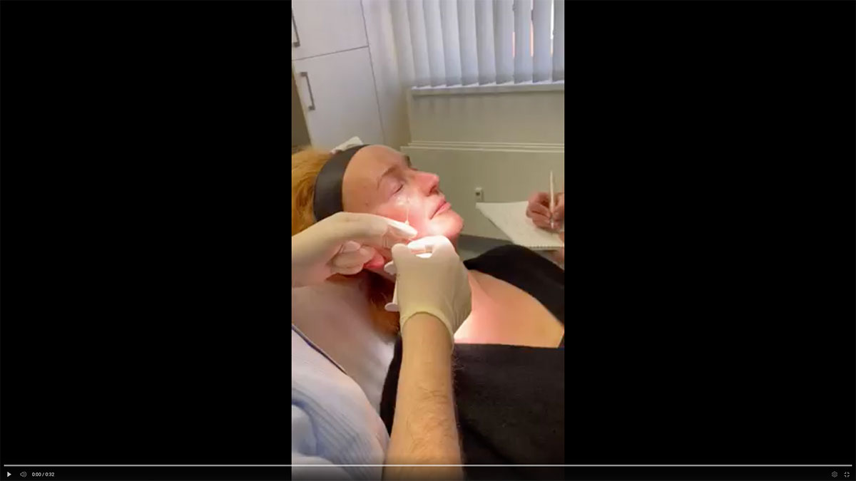 Video: Dr. med. Woltersdorf: Hyaluron-Behandlung der Tränenrinne